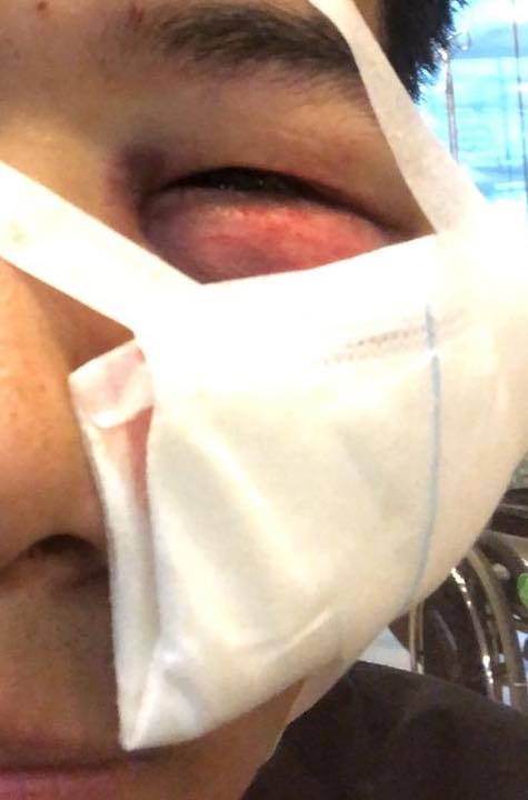 男子被橡膠彈擦面而過，血痕至少3厘米長。網圖