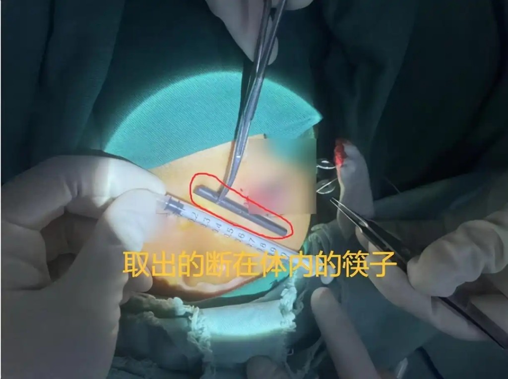 5cm長的斷筷從眼眶中完整取出。