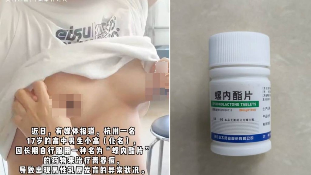 17歲男生小高擅食藥醫暗瘡，令乳房異常發育。示意圖。南華視頻