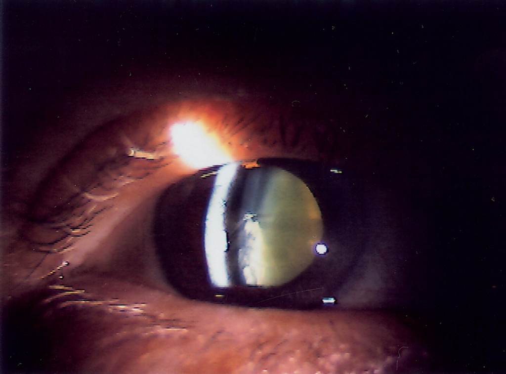 眼疾雖絕少致命，視力受損卻可大大影響患者的生活質素。