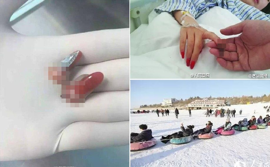 少女兩根手指被監生扯斷。網圖