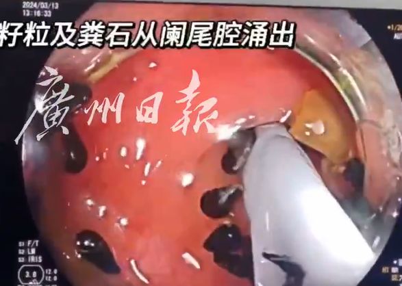郭醫生在內視鏡發現阿山的闌尾管腔有十幾顆西瓜籽。 廣州日報