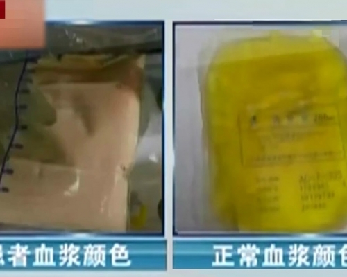 患者抽出來的血竟呈「 豬油色」。　網上圖片