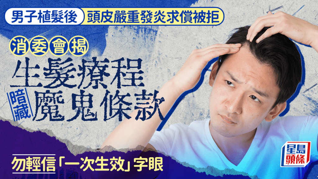 消委會植髮投訴｜療程後頭皮嚴重發炎求償被拒 小心暗藏魔鬼條款 勿輕信「一次生效」字眼