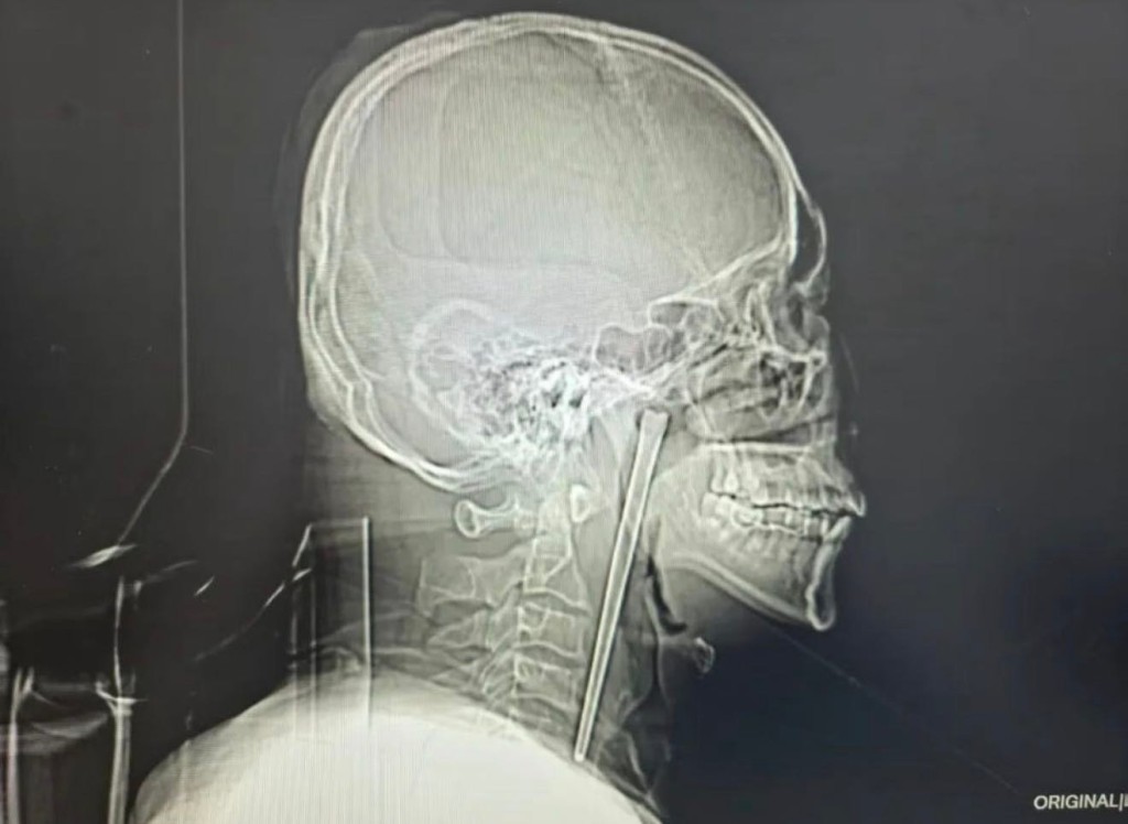 網傳男子咽喉留有筷子。《瀟湘晨報》