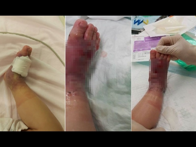 網上流傳B女打豆後出現腳腫潰爛照片。fb群組圖片