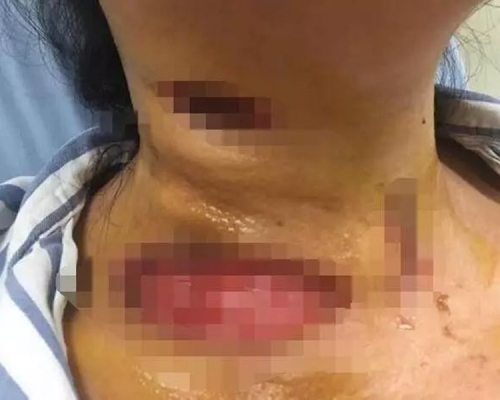 馬女士頸胸部被食肉菌吃掉一大片,留下創口。(網上圖片)
