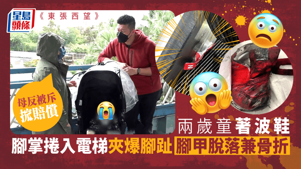 東張西望｜兩歲B著波鞋腳掌捲入電梯夾爆腳趾 腳甲脫落兼骨折母轟職員冷漠反被斥搲賠償