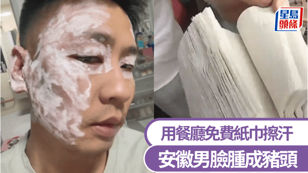 用餐廳紙巾擦汗後險毀容，安徽男臉腫成豬頭。