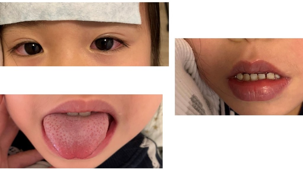 儿童多系统发炎综合症的病徵包括发烧、红眼、皮疹及口腔黏膜转变（俗称士多啤梨脷）等。
