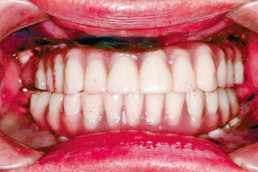 黎博士指,現代植牙可媲美天然牙齒,使用壽命長。 黎博士指,現代植牙可媲美天然牙齒,使用壽命長。