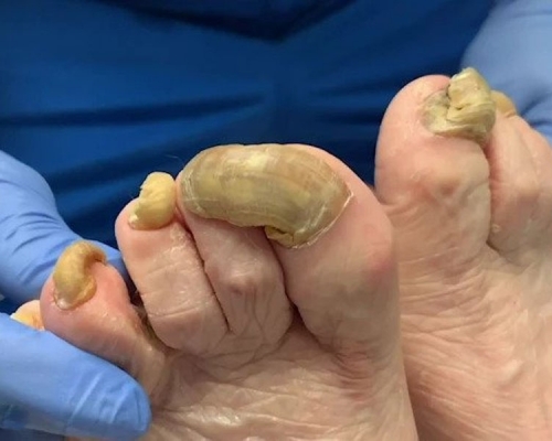 美國一名女子，長達一年都沒有修剪過自己的腳趾甲，不僅讓腳趾甲變厚變黃，甚至還遭到真菌感染。(網圖)