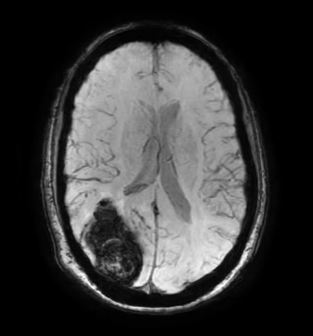 扫描显示南达科他州患者大脑中有血液凝块。网图