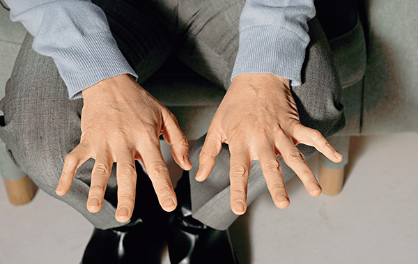 四十年下来，甄子丹已数不清身上因工作而来的伤患，但肉眼可见的，是他两手已变形的尾指，还有手指上一些已结疤的伤痕。