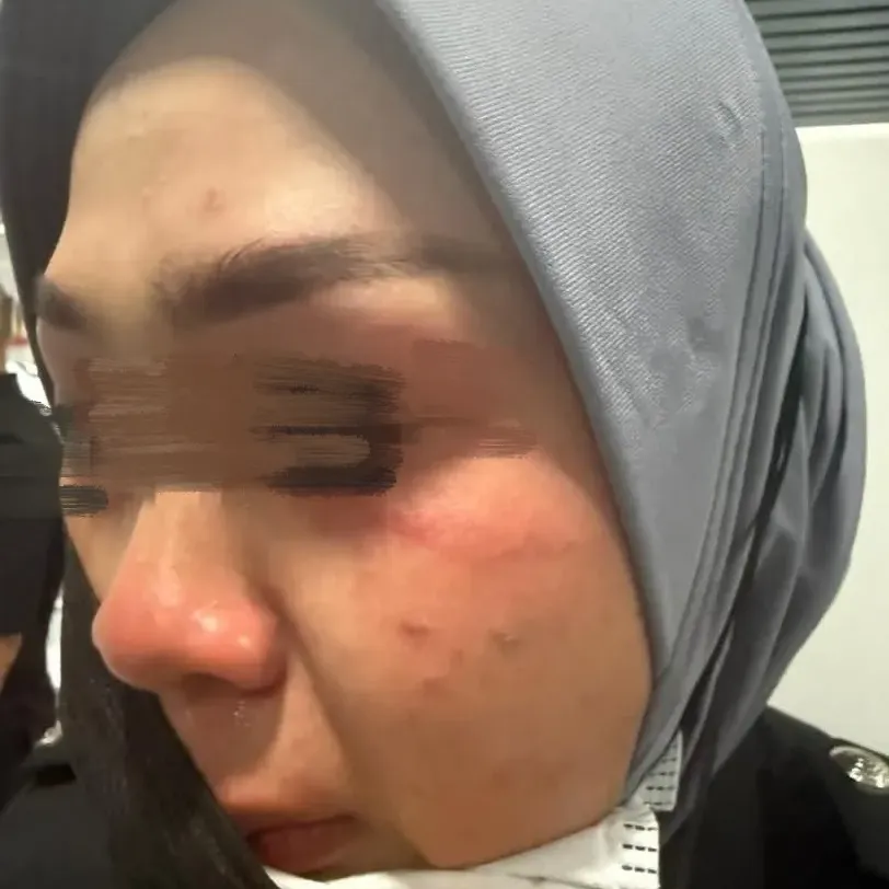 被中国女游客袭击的大马女移民官眼部红肿。Threads@rizalhakimm_punyer 被中国女游客袭击的大马女移民官眼部红肿。Threads@rizalhakimm_punyer