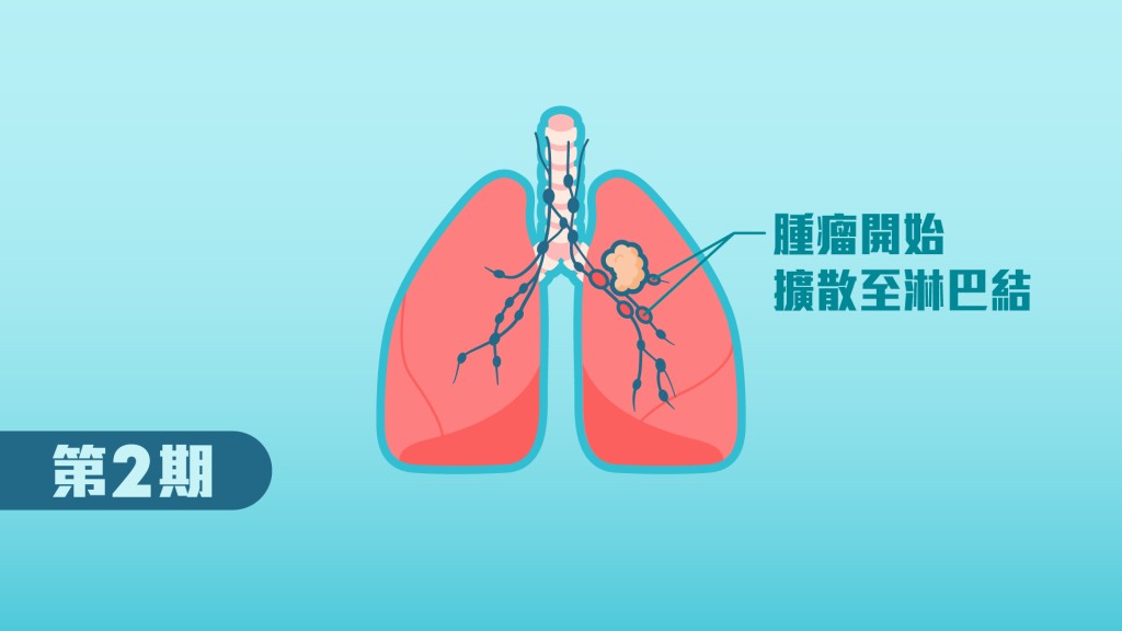 第2期肺癌