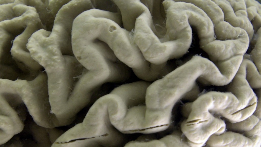 在紐約水牛城大學神經解剖學博物館展出的阿茲海默症患者腦部特寫照片。 美聯社