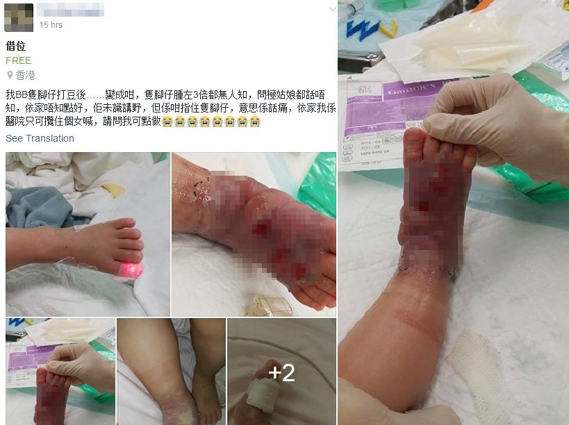 網上流傳B女打豆後出現腳腫潰爛照片。fb群組圖片