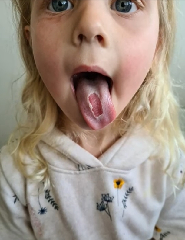 妈妈由于太过气愤，便将女儿舌头起泡的照片在网上公开。