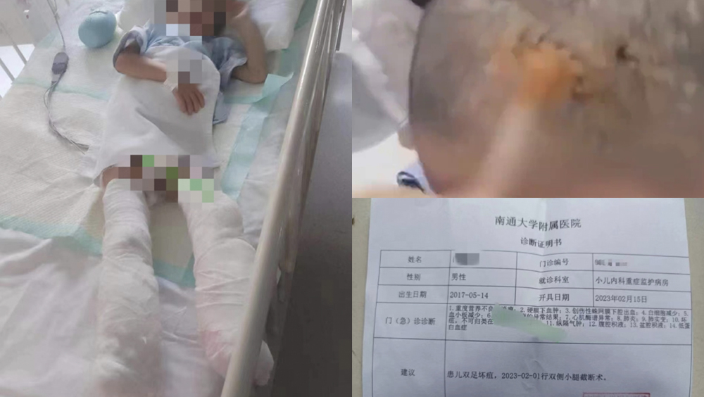 江蘇5歲男童被生母虐待致截肢，官方：母親已被批捕。