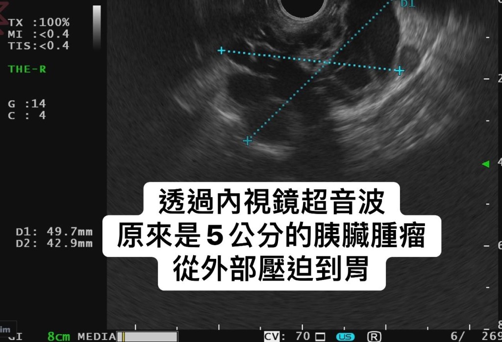 进一步接受胰脏超声波内窥镜检查，最终在胰脏尾部找到5cm大小的肿瘤，且有癌变风险。（图片来源：林相宏医生Facebook）