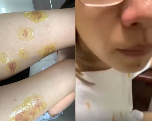 5人火鍋爆炸被燙傷，索賠不成。店主稱他們索賠要求太高。(網圖)