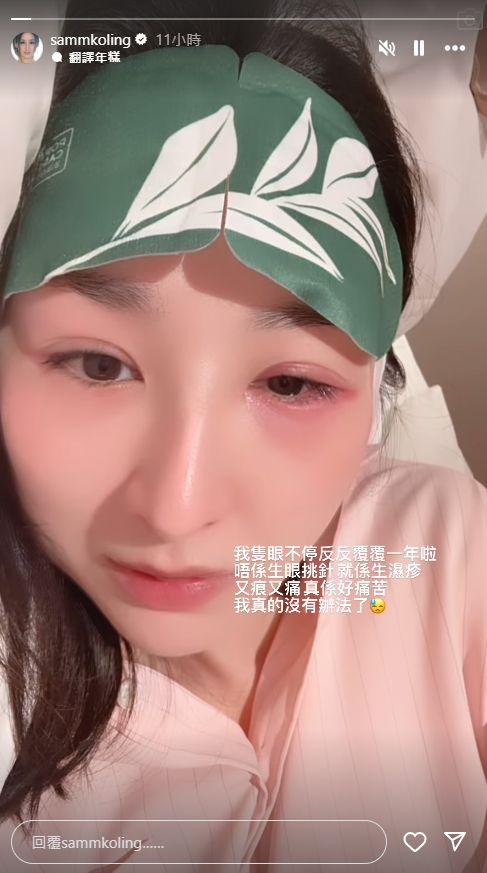 高海寧今日在IG的限時動態貼出眼腫相。 高海寧今日在IG的限時動態貼出眼腫相。