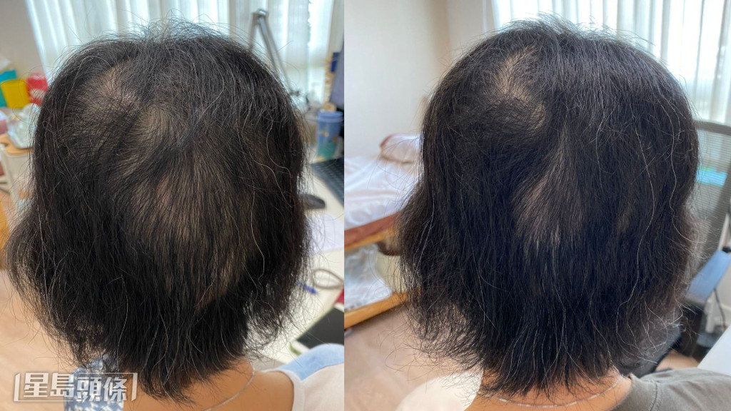 治療前後，該患者髮量明顯不同。李醫師指出，若對方沒積極治療，有機會變成「全禿」。（相片由註冊中醫師李灼梅提供）