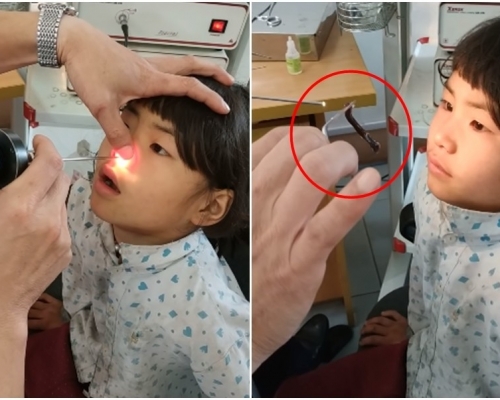 醫生竟從越南小女孩鼻腔內夾出肥大水蛭。(網圖)
