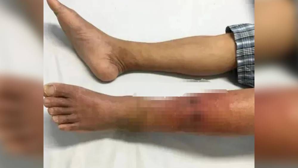 深圳200磅大叔愛𢯎腳右腿腫成「豬蹄」，醫生揭「指尖隱形殺手」。