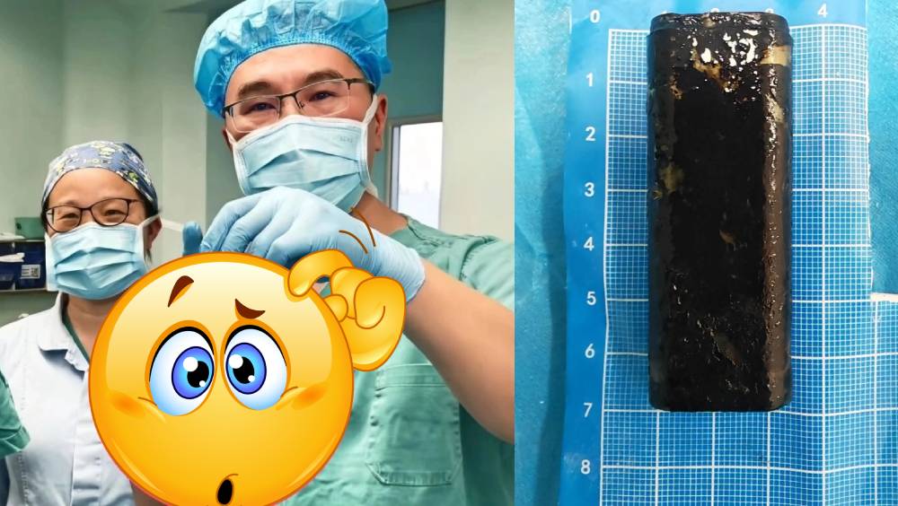 四川醉漢打賭吞下打火機，30年後腹痛才就醫取出。