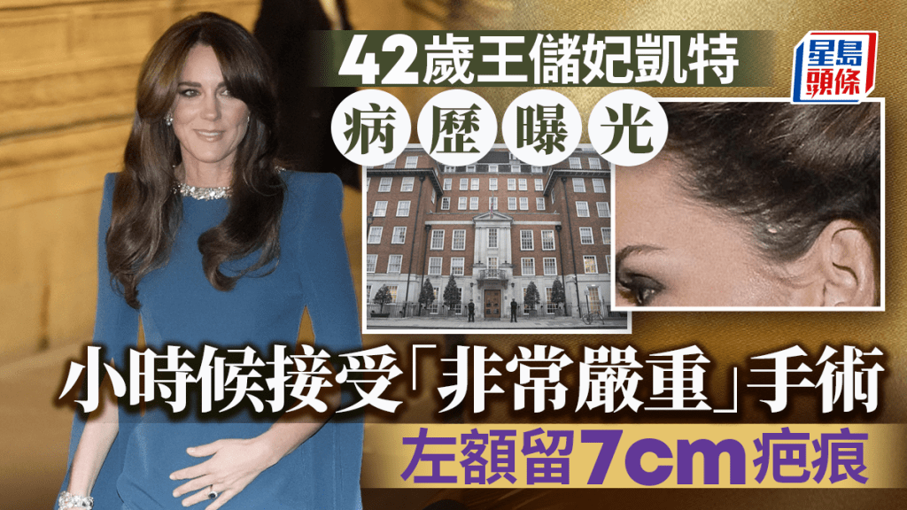 英國凱特皇妃健康史曝光  小時頭部曾接受「非常嚴重手術」留3英寸疤痕