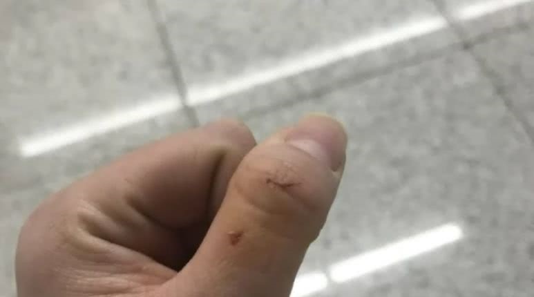 手指也被抓损。网图