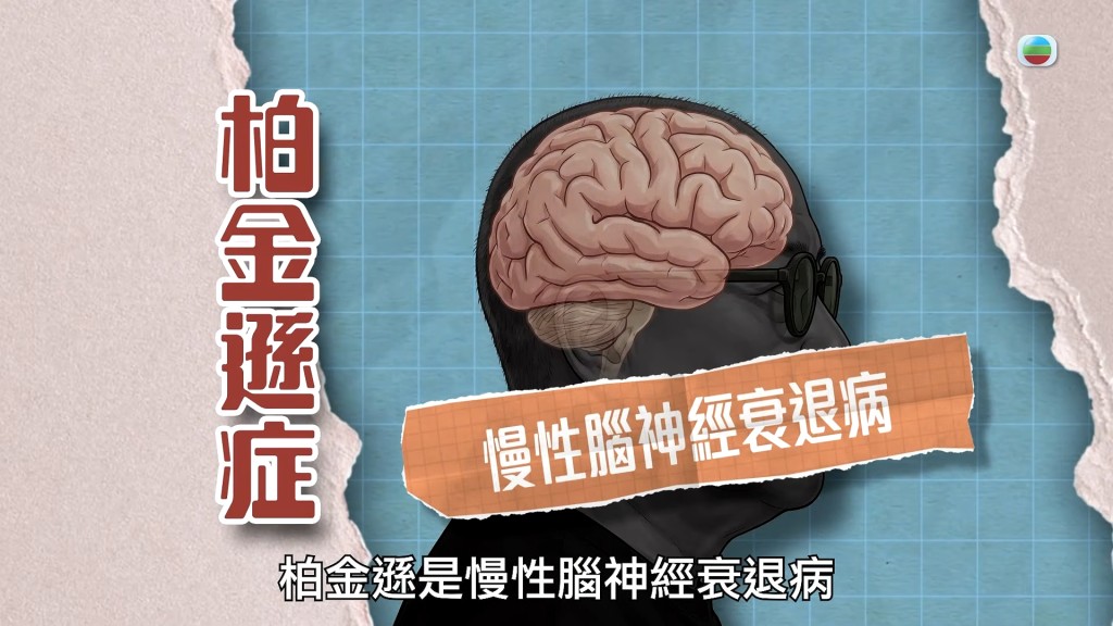 嚴秉泉醫生稱原來係早期柏金遜症。