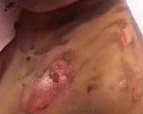 小學生用熱水燙傷女同學,校方已免去其母副校長職務。(網圖)