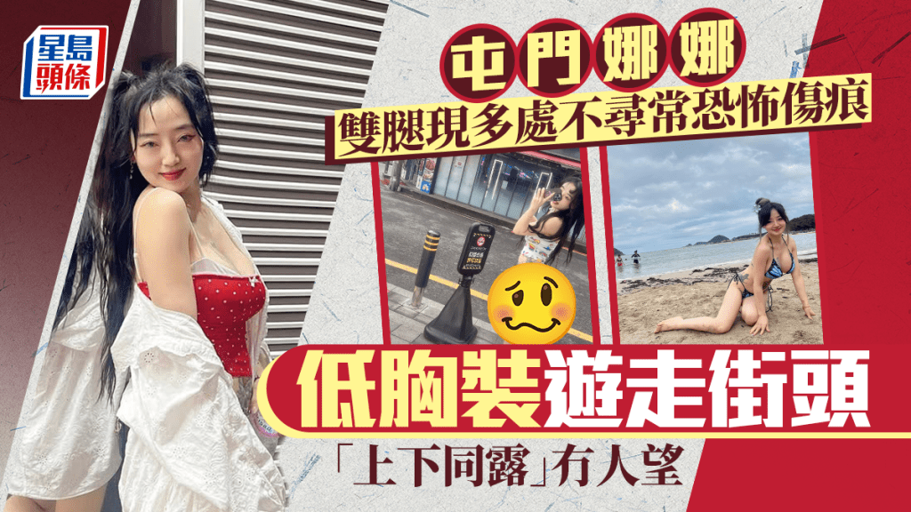 屯門娜娜雙腿突現多處不尋常恐怖傷痕  低胸裝遊走街頭 「上下同露」晒豐滿上圍冇人望