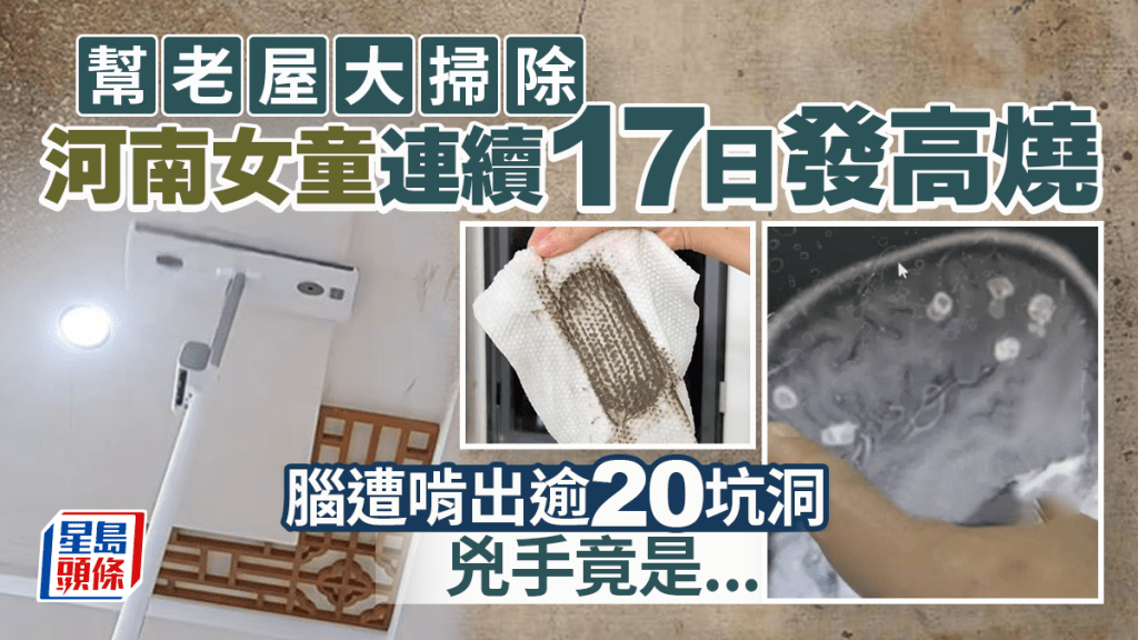 大扫除︱河南6岁女发烧17日  做漏一事脑遭啃出逾20坑洞