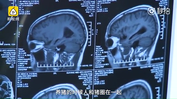 男子的腦裏長滿寄生蟲，形成梗阻。（網圖）