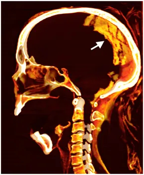 檢查顯示「尖叫木乃伊」篩板完整，保存完好的乾燥大腦位於頭骨後部（箭嘴所示）。 Sahar Saleem