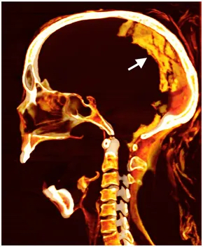 检查显示「尖叫木乃伊」筛板完整，保存完好的乾燥大脑位于头骨后部（箭嘴所示）。 Sahar Saleem