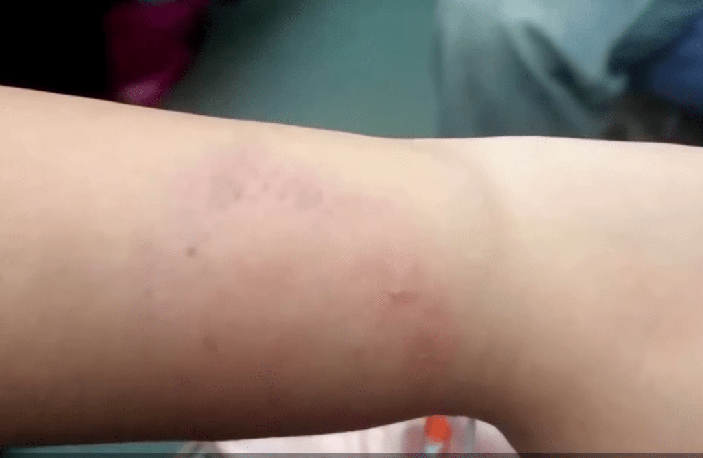 女事主称遭大妈咬伤手臂后起疱疹。