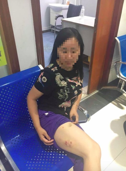 被猴子咬傷的遊客張女士。(網圖)