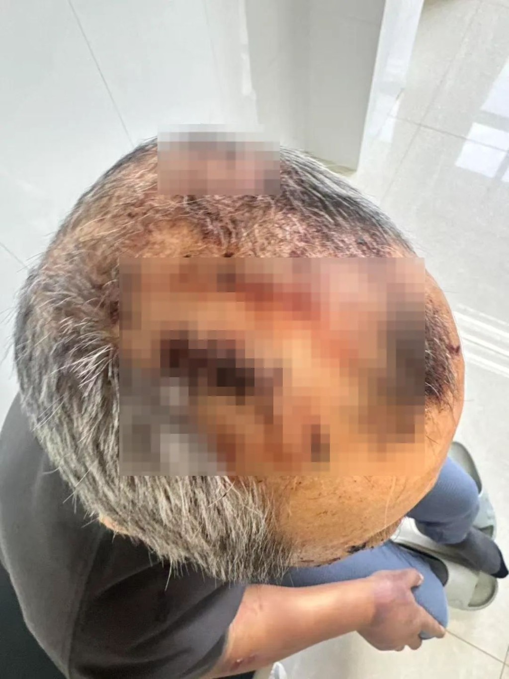 马女士父亲遭安老院室友狂殴两小时。红星新闻