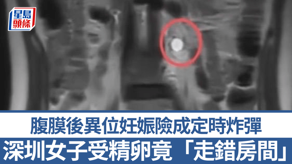 深圳女子受精卵竟「走錯房間」險成「定時炸彈」。風芒新聞
