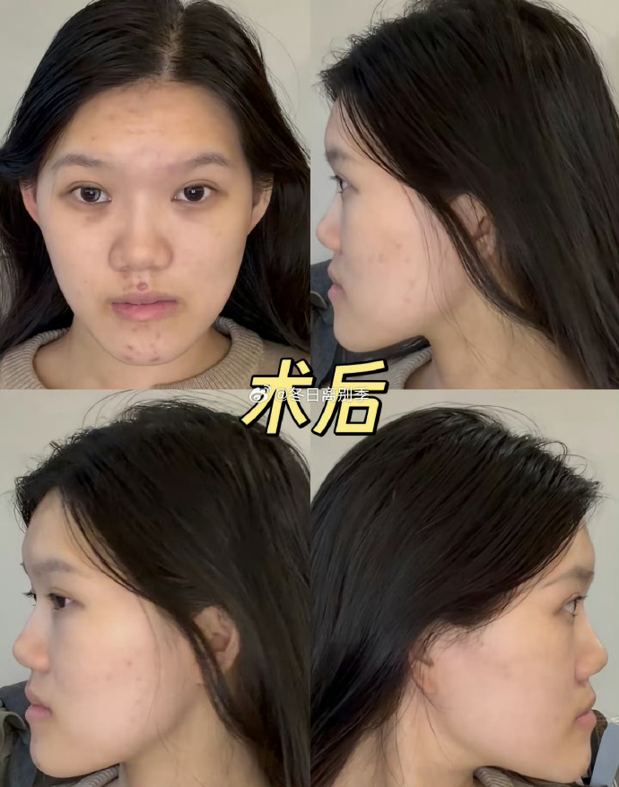 小雨术后状态。