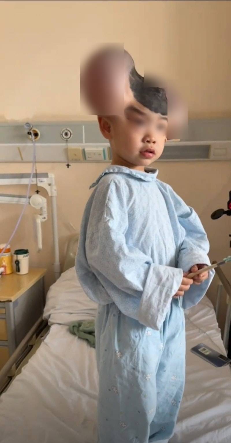 接受第二次手術前琪寶要頂著「米奇老鼠」頭示人。抖音@美俠小頭 接受第二次手術前琪寶要頂著「米奇老鼠」頭示人。抖音@美俠小頭