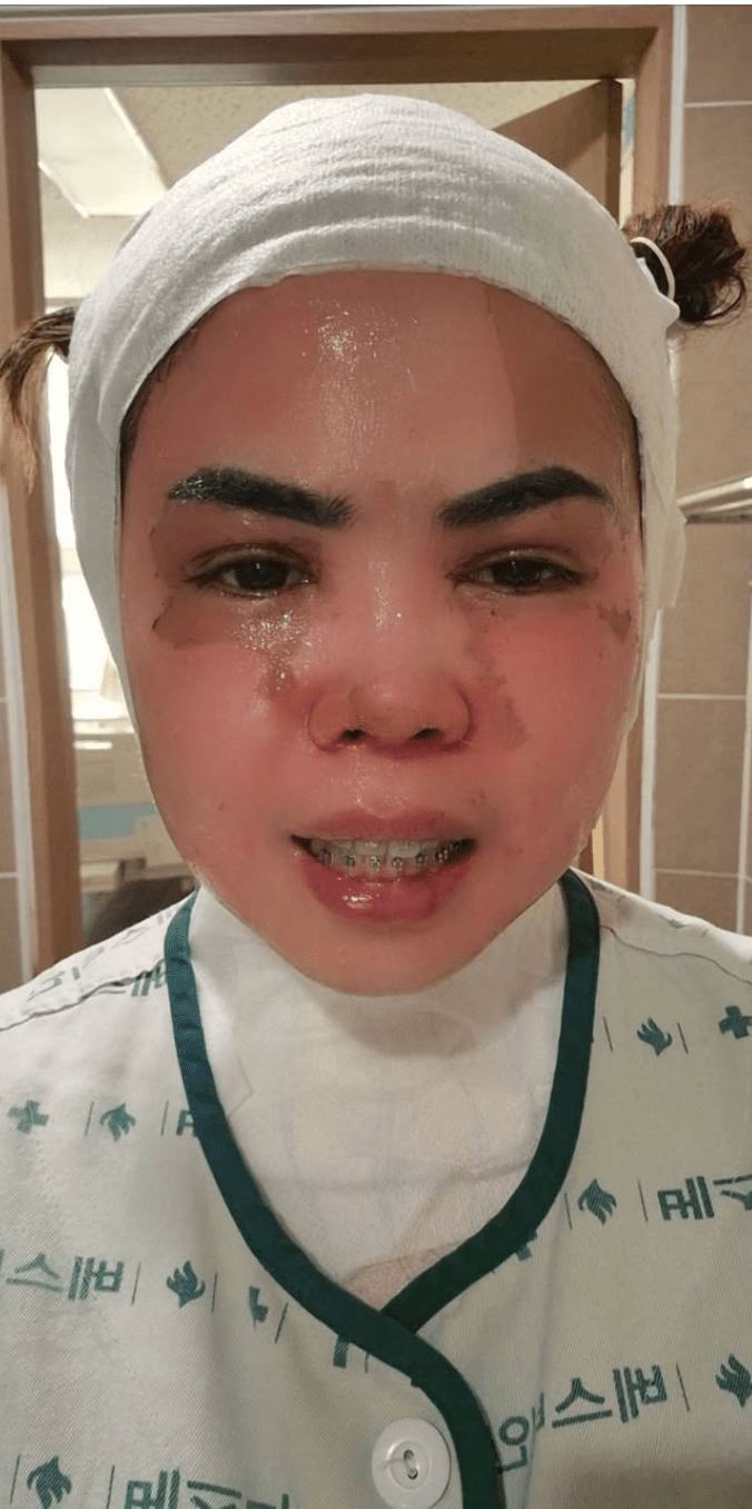 一名當地男子懷疑泰籍妻子出軌，竟趁她熟睡時，將滾燙的熱水潑向其臉部及頸部，導致妻子全身多處二度燒燙傷。Facebook@NNutt AAomsin