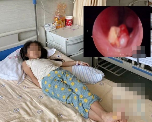 醫生將女童鼻內的牙齒完整拔出。 網圖