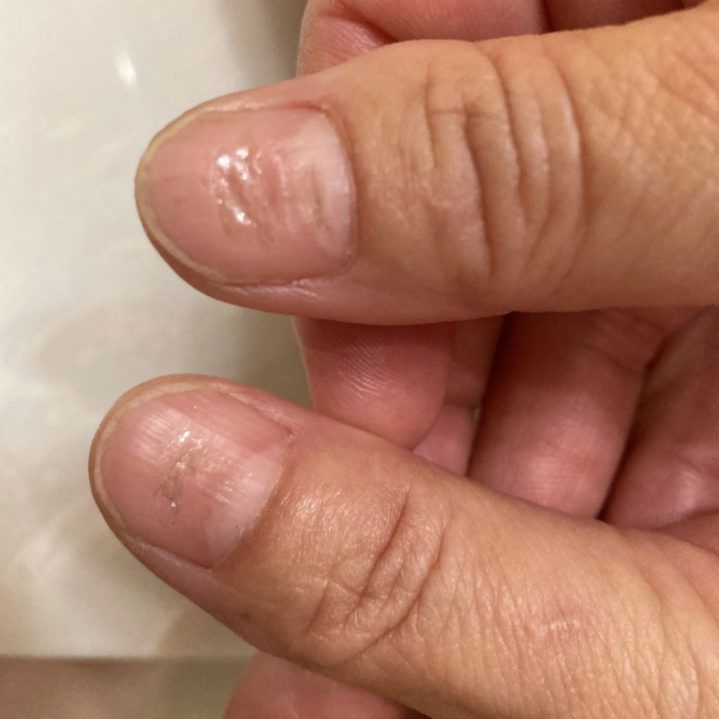 照片所見，女事主的兩隻大拇指指甲上同樣出現凹陷型橫紋，彷彿曾遭硬物撞傷。（Facebook圖片）