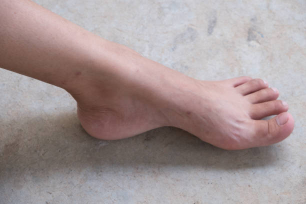 感染个案大多都是因脚部伤口感染发病。iStock图片